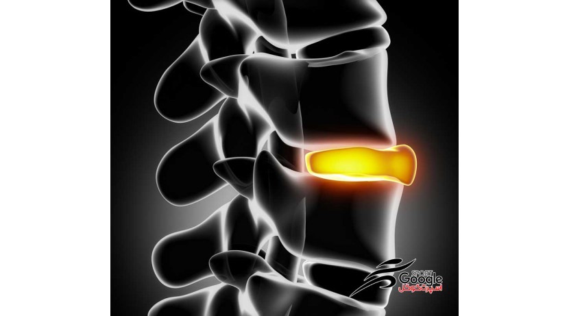 درمانهای خانگی دیسک کمر تردمیل